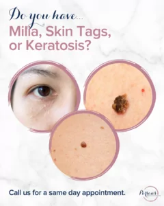 Milia, keratosis, skin tags