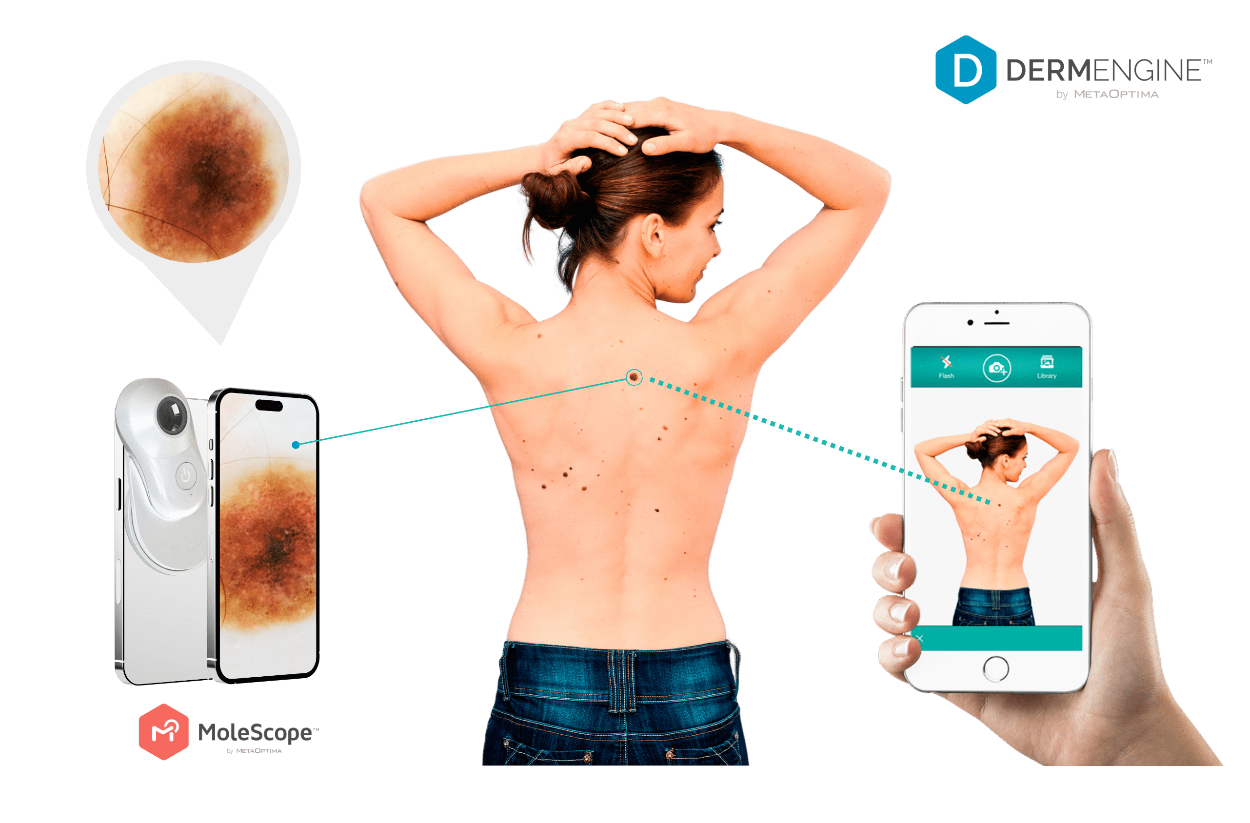 MoleMapping_DermEngine_woman MoleMapping_DermEngine_woman