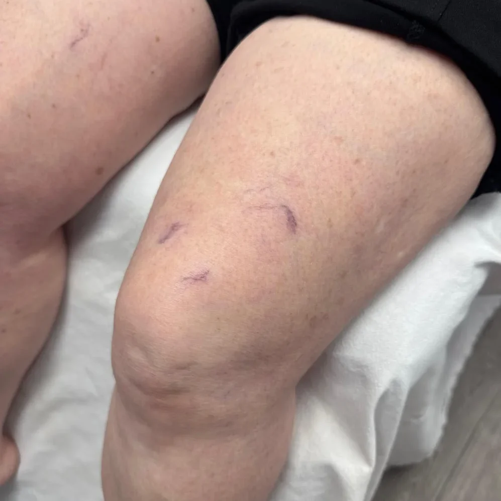 Leg Vein After