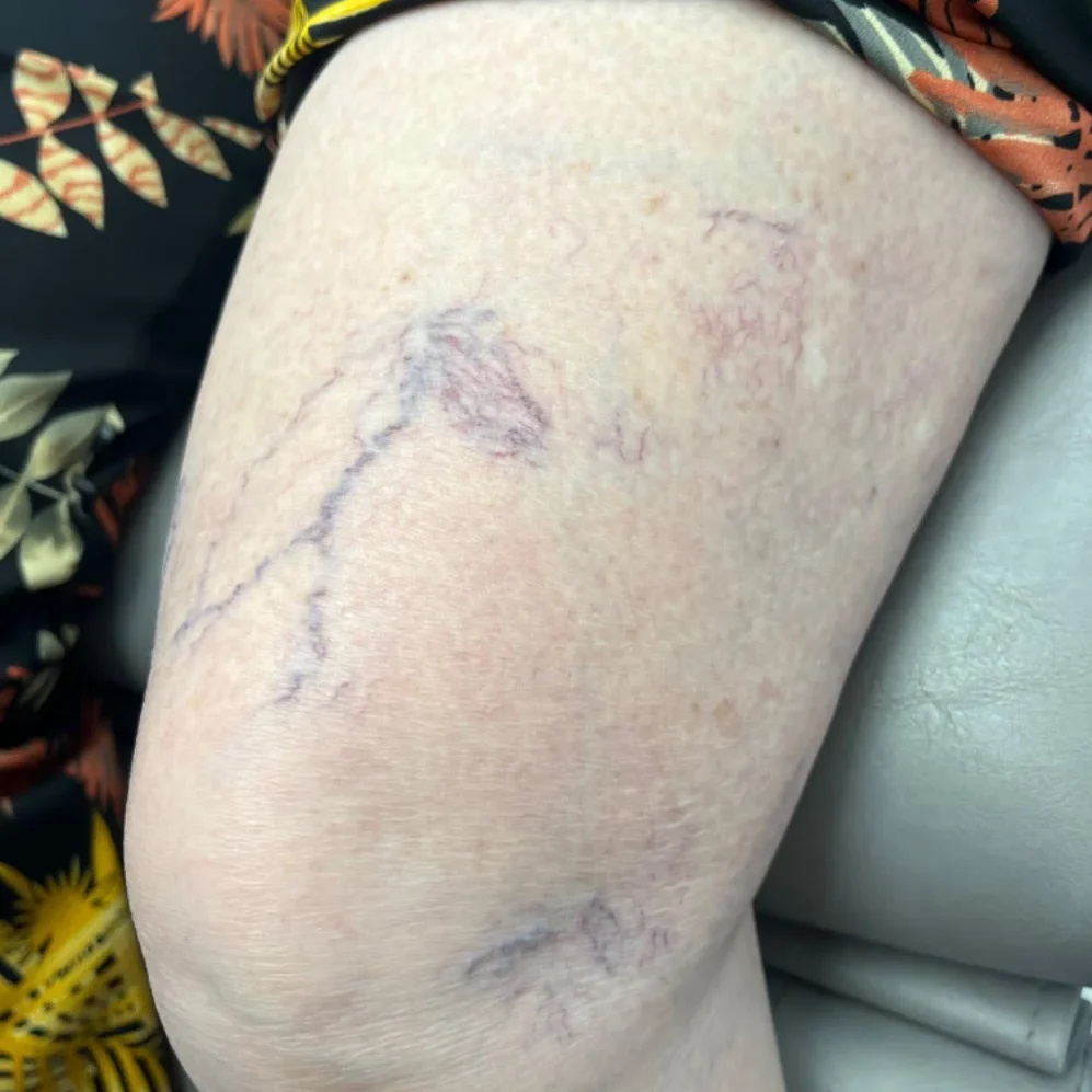 Leg Vein Before